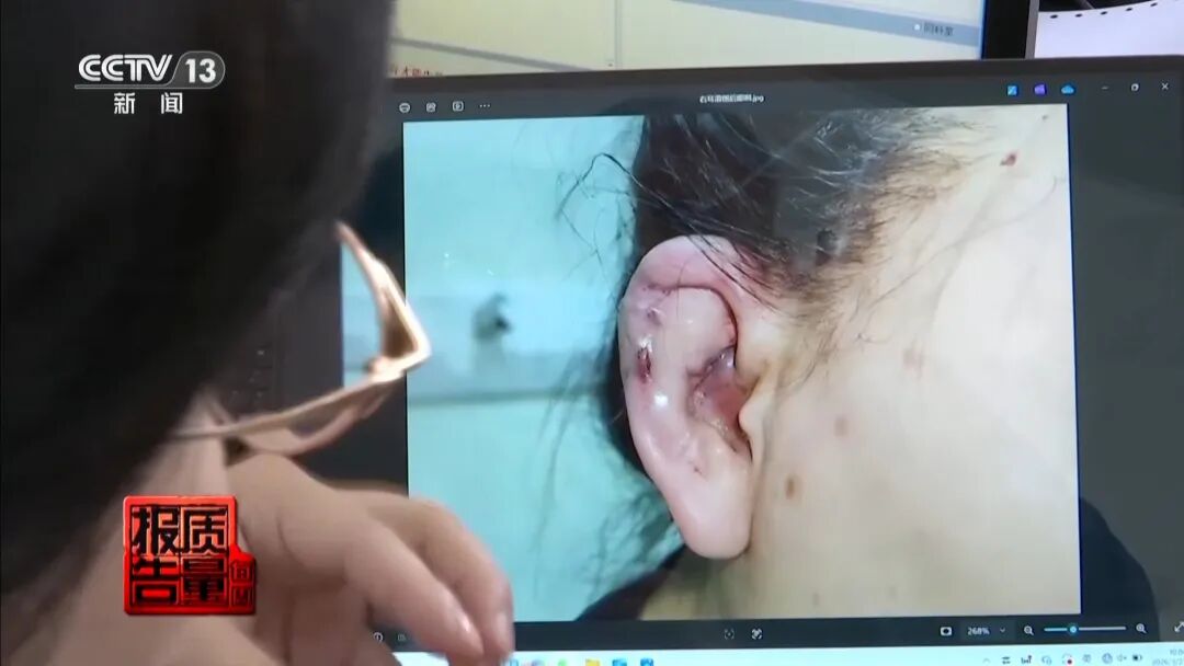 行业关注|央视曝光“精灵耳”医美项目安全乱象